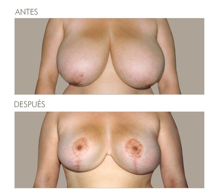 Mastopexia