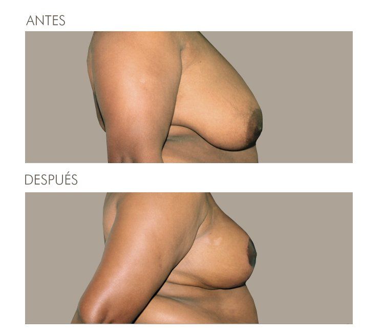 Mastopexia