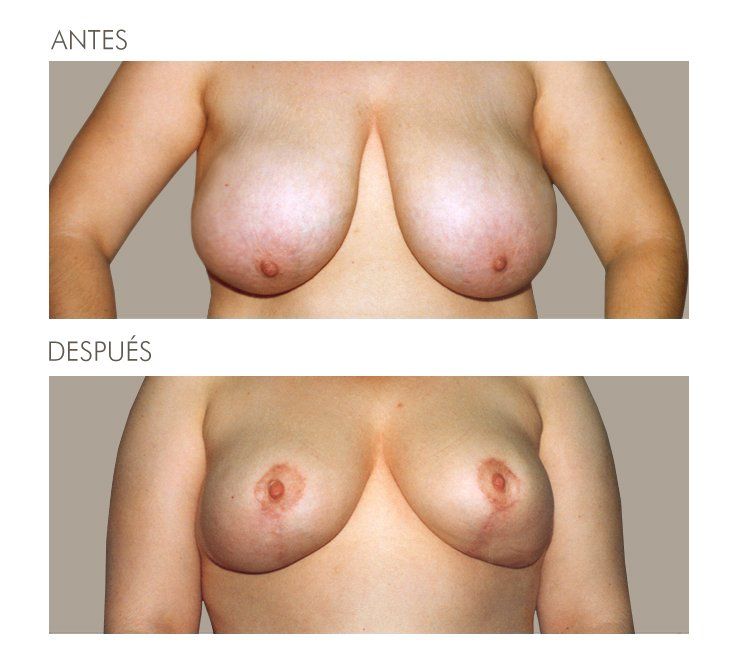 Mastopexia