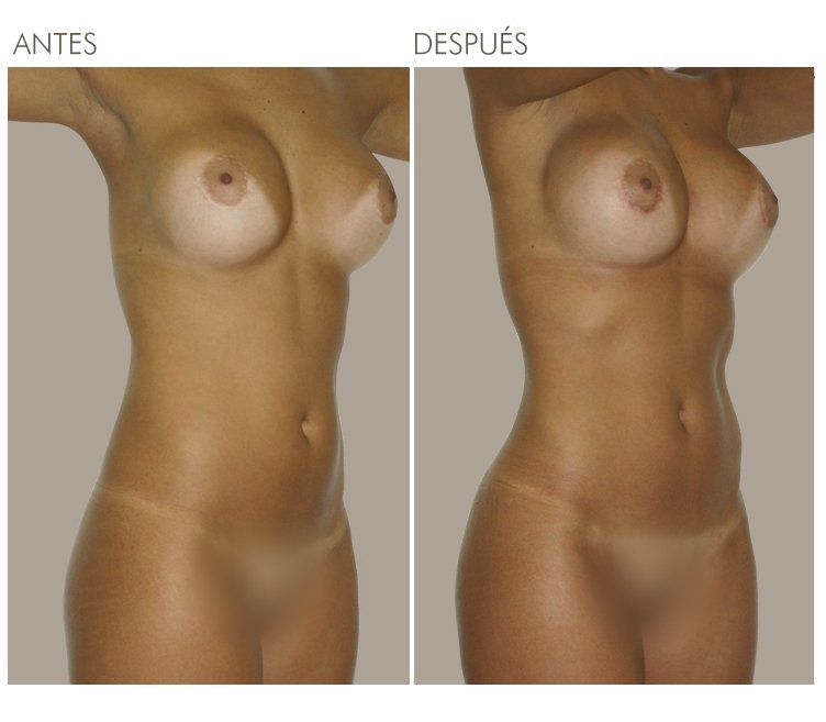 LIPOESCULTURA