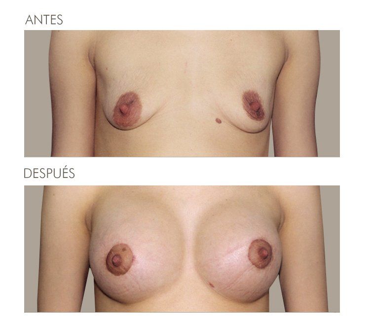 Mastopexia