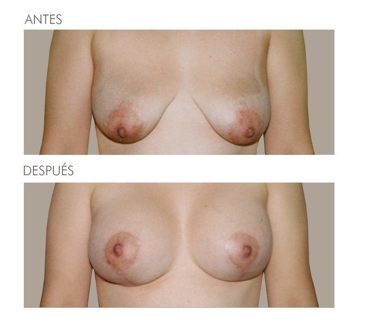Mastopexia