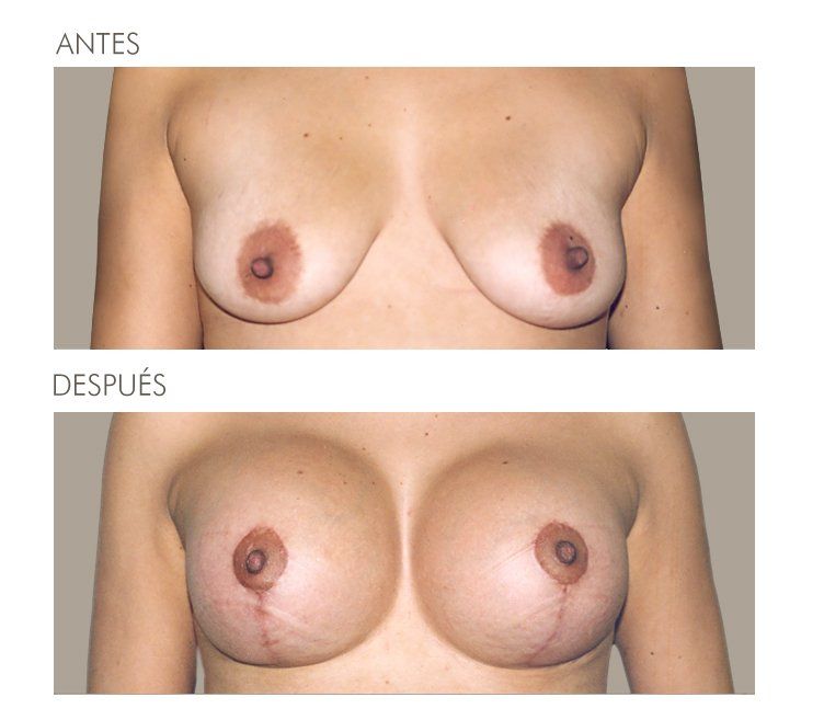 Mastopexia