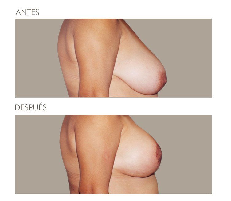 Mastopexia
