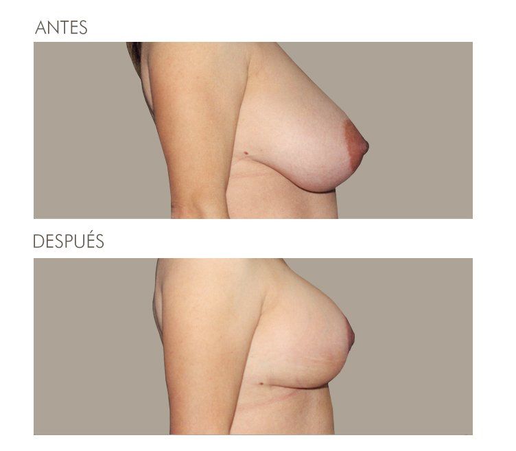 Mastopexia