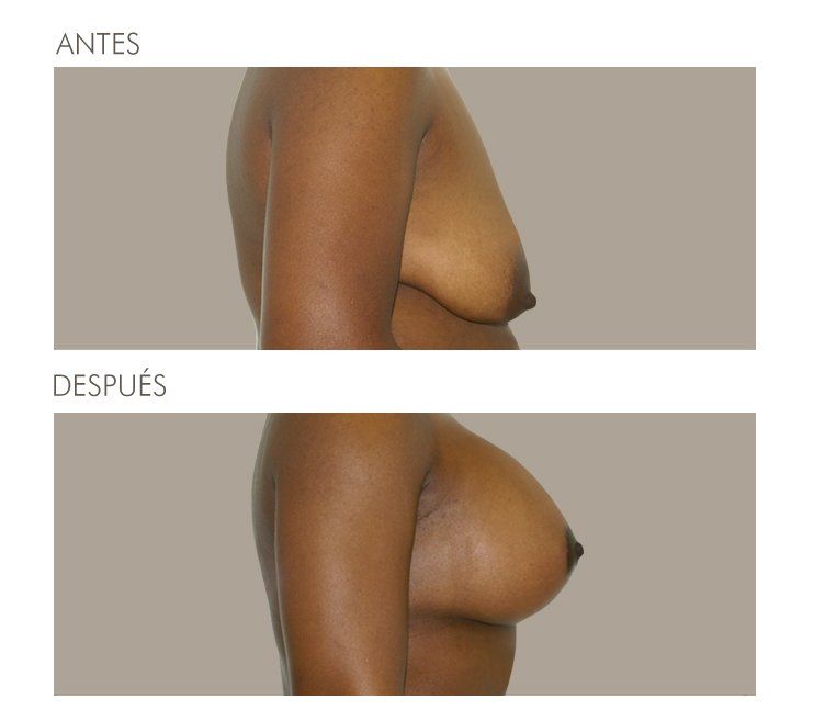 Mastopexia