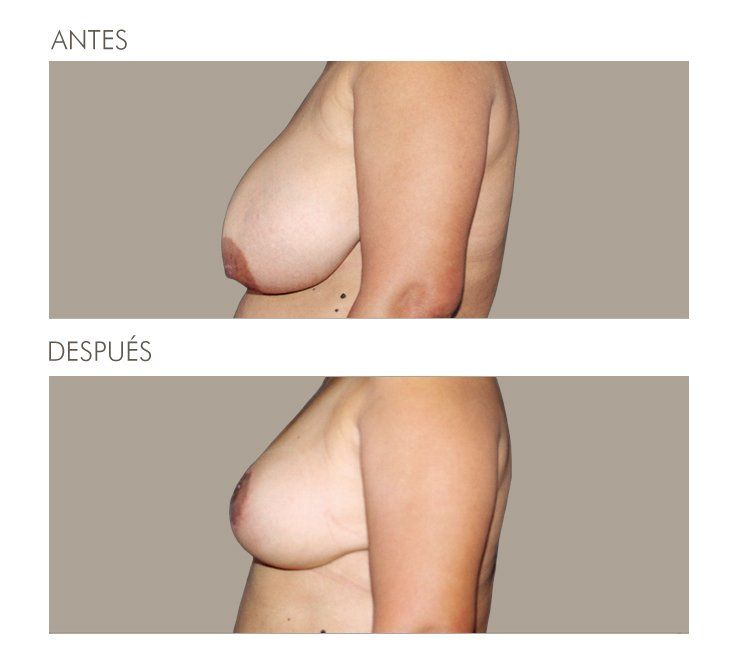 Mastopexia