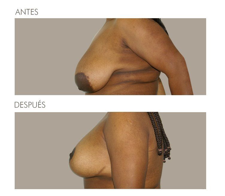 Mastopexia