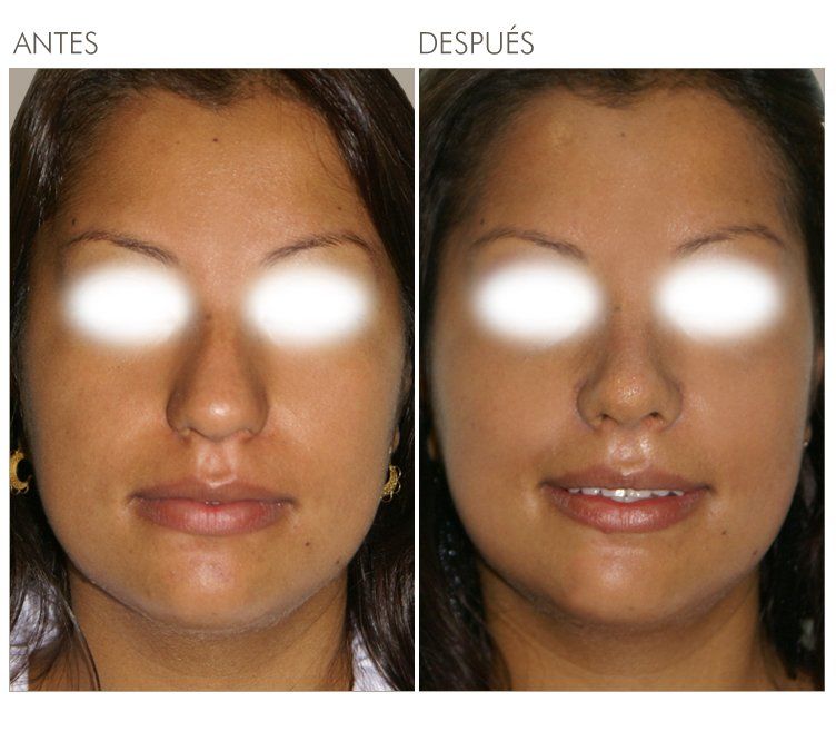 A before and after photo of a woman 's face