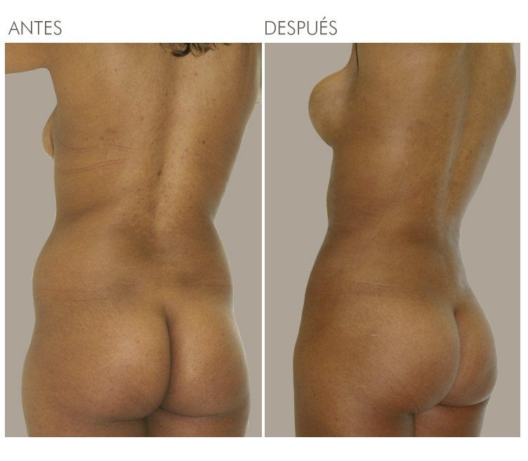 LIPOESCULTURA
