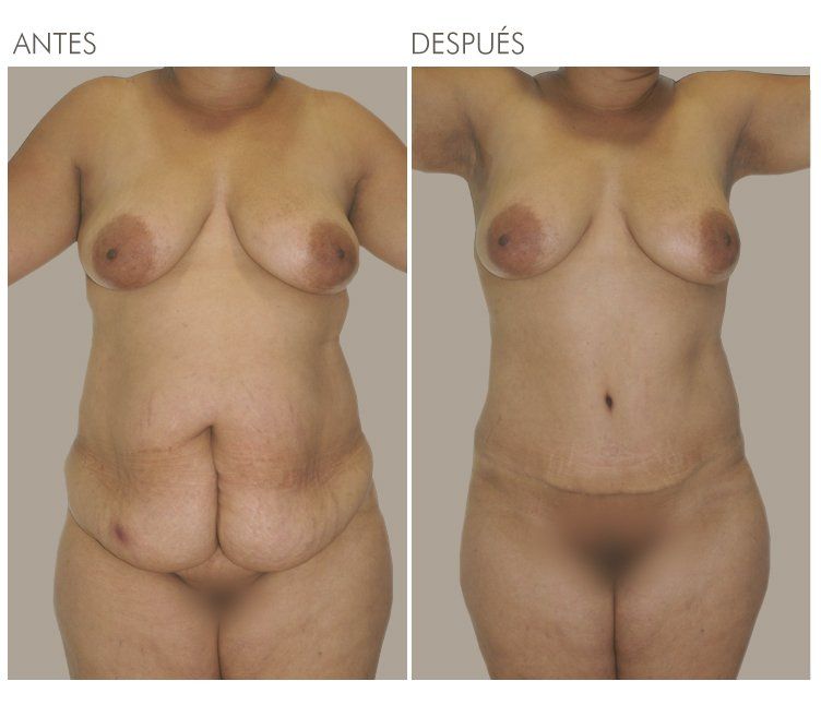 ABDOMINOPLASTIA