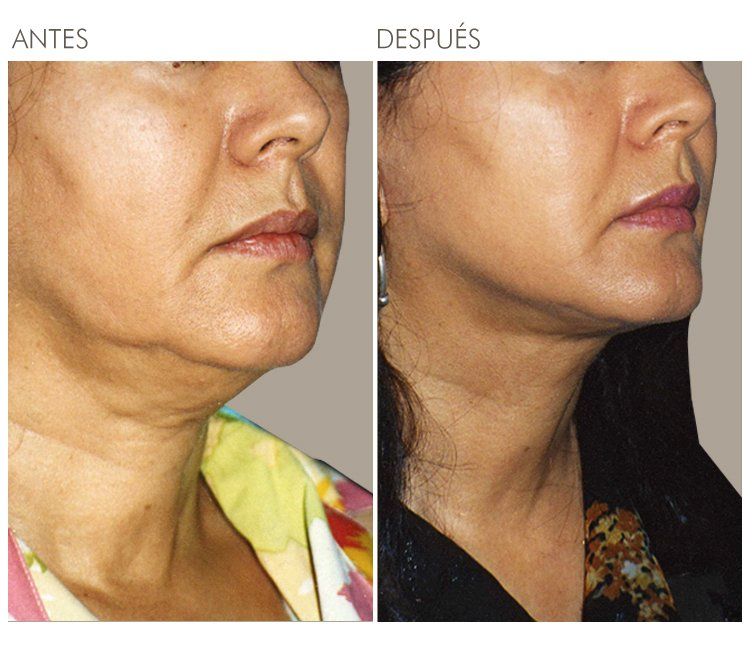 A before and after photo of a woman 's face and neck