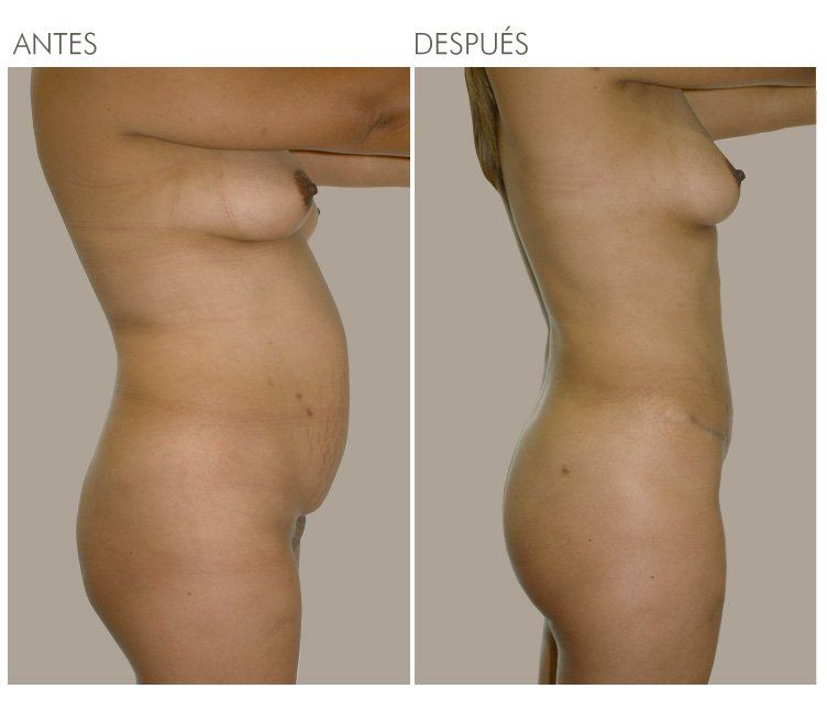 ABDOMINOPLASTIA