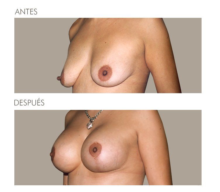 Mastopexia