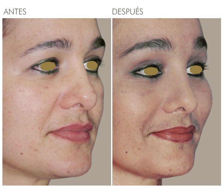 A before and after photo of a woman 's face