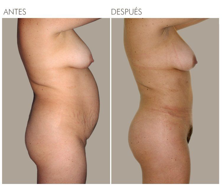 ABDOMINOPLASTIA