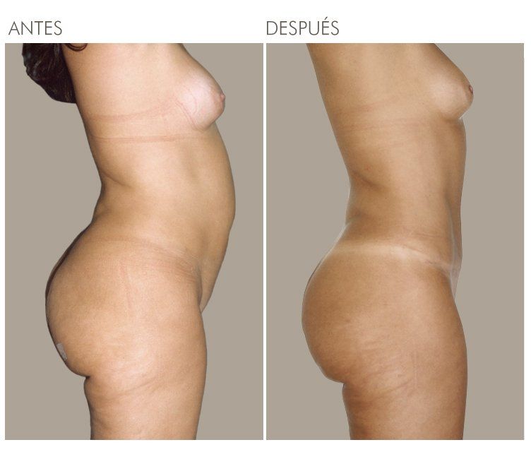 ABDOMINOPLASTIA