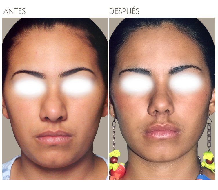 A before and after photo of a woman 's face