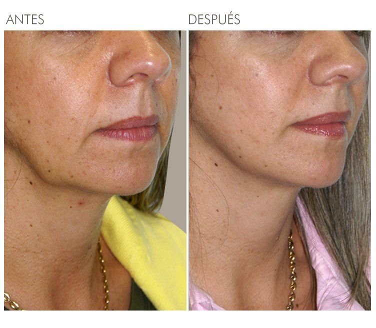 A before and after photo of a woman 's face