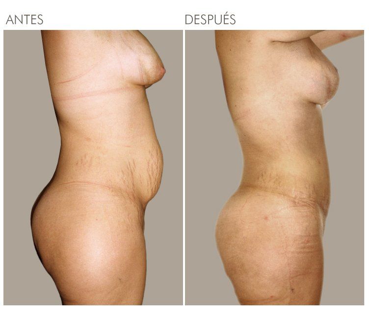 A before and after photo of a woman 's body