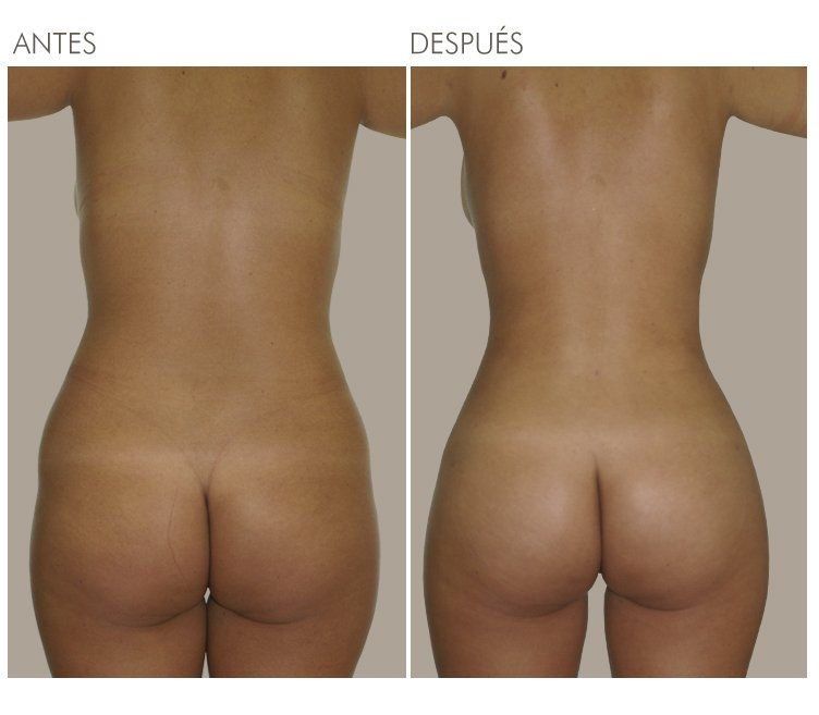 LIPOESCULTURA
