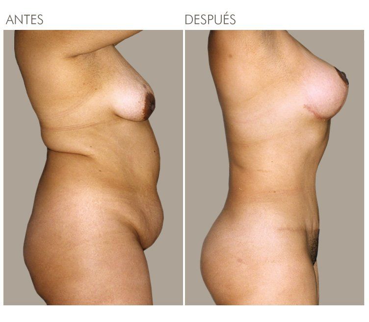 ABDOMINOPLASTIA