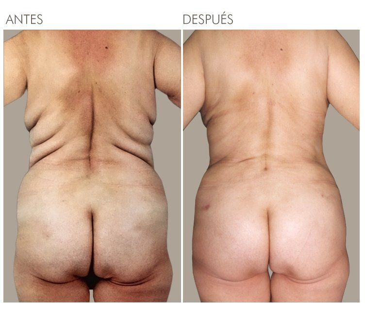 LIPOESCULTURA