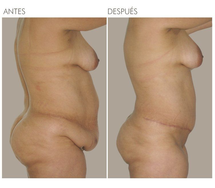 ABDOMINOPLASTIA