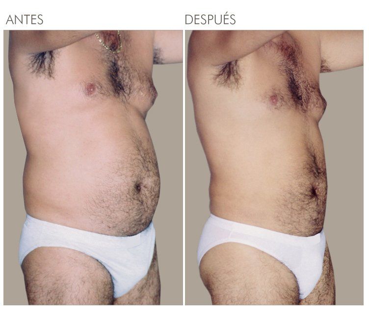 A man 's torso is shown before and after surgery