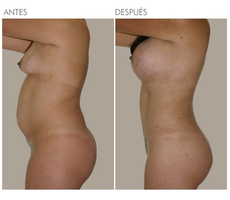 A woman 's torso is shown before and after surgery