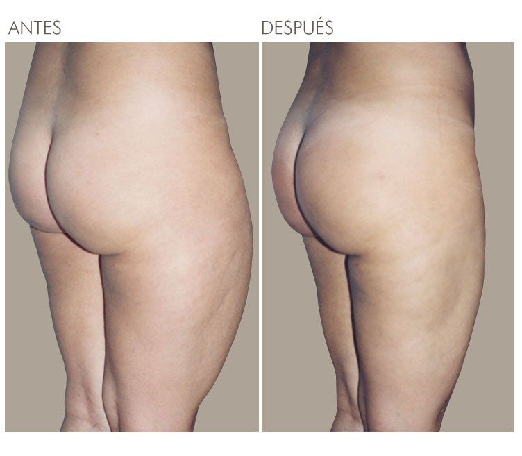 LIPOESCULTURA