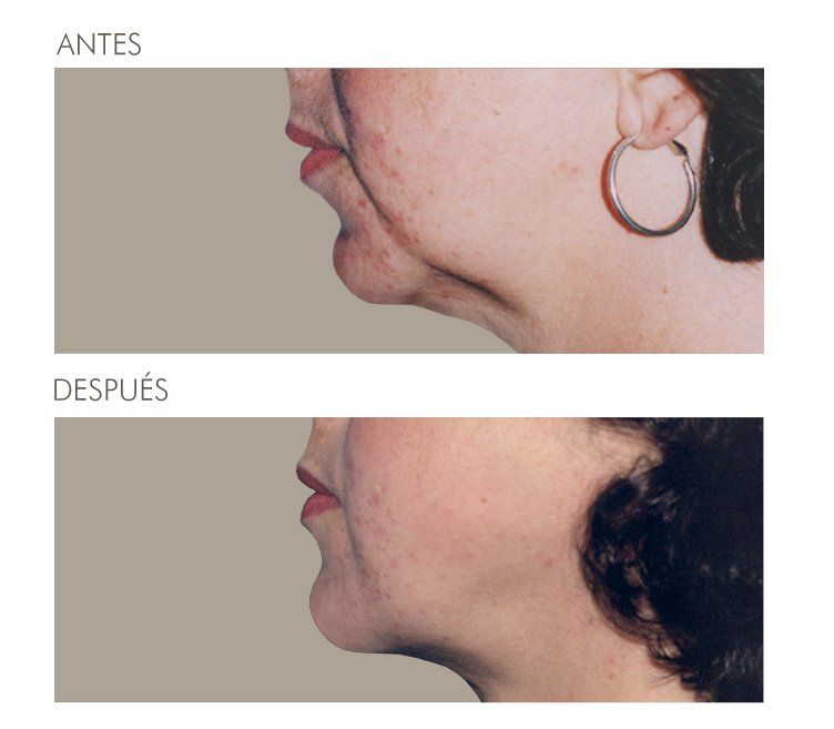 A before and after photo of a woman 's face