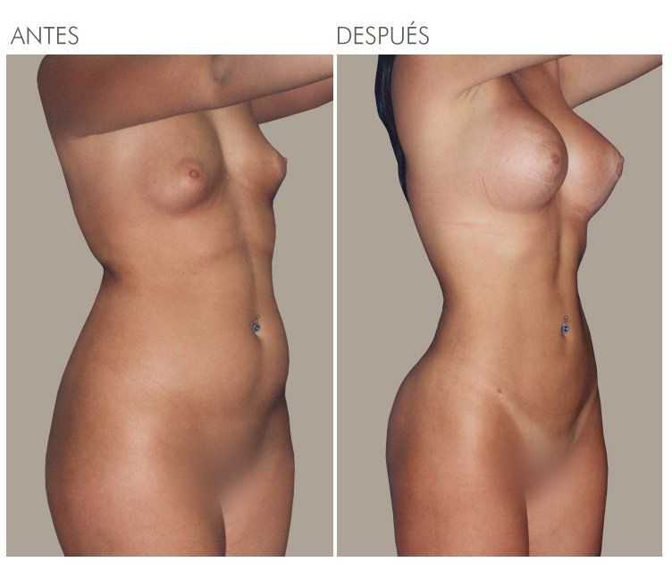 LIPOESCULTURA