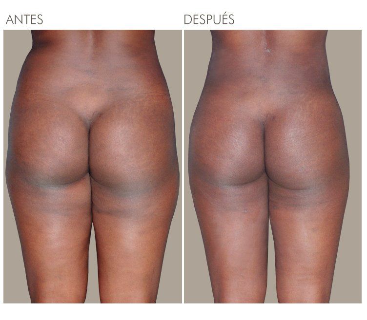 LIPOESCULTURA