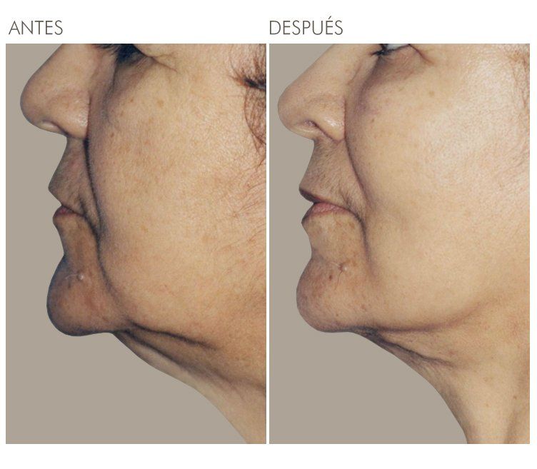 A before and after photo of a woman 's face