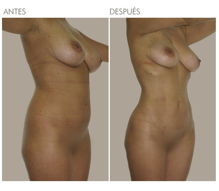 LIPOESCULTURA