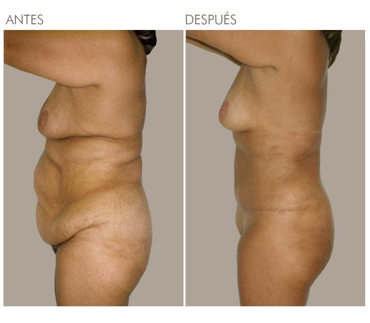 ABDOMINOPLASTIA