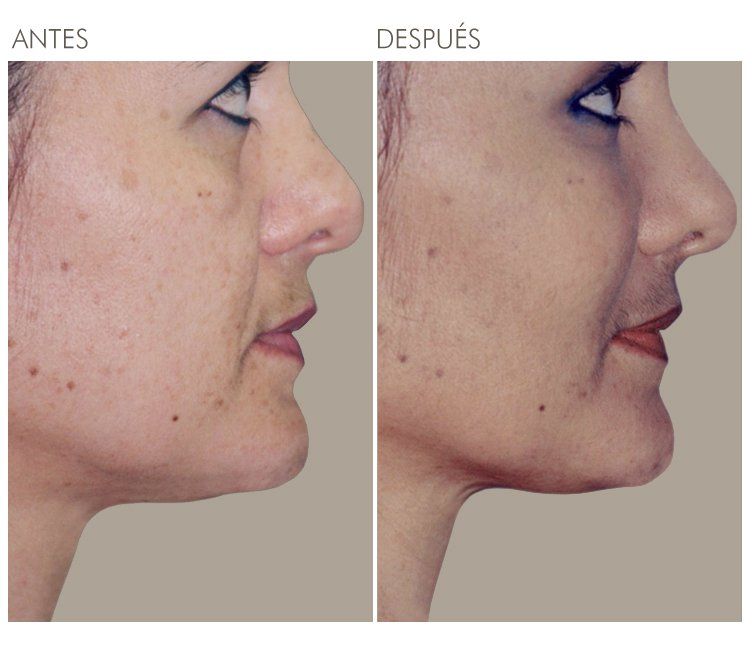 A before and after photo of a woman 's face