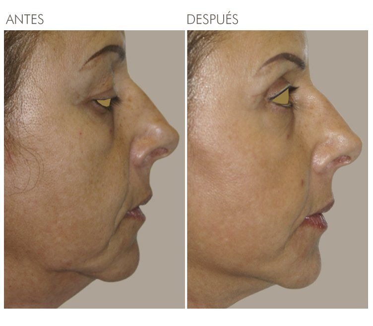 A before and after photo of a woman 's face