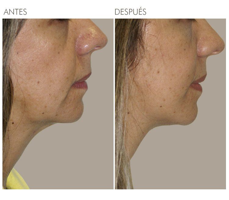 A before and after photo of a woman 's face
