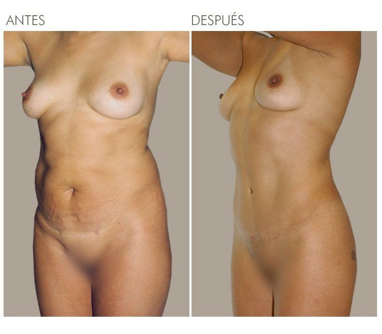 ABDOMINOPLASTIA