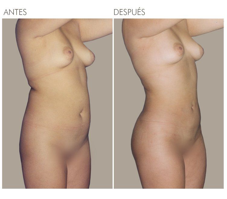 LIPOESCULTURA