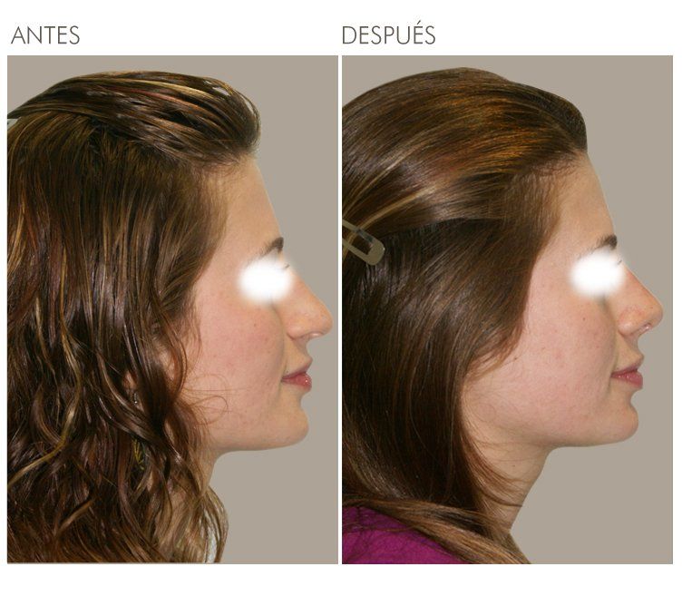 A before and after photo of a woman 's face