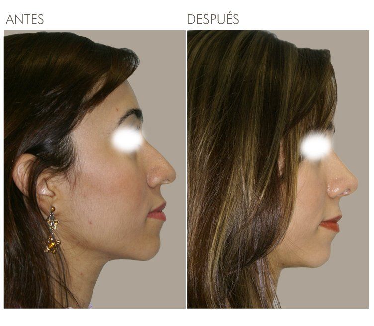 A before and after photo of a woman 's face