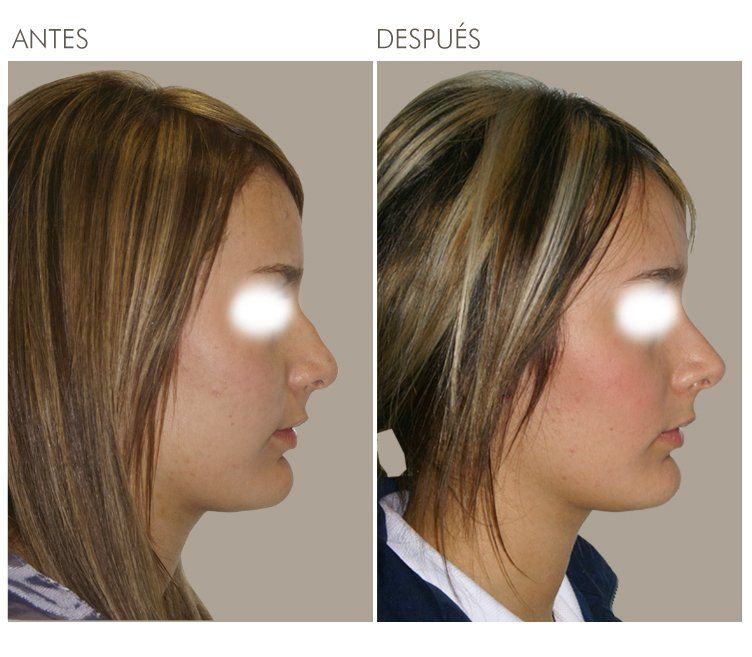 A before and after photo of a woman 's nose