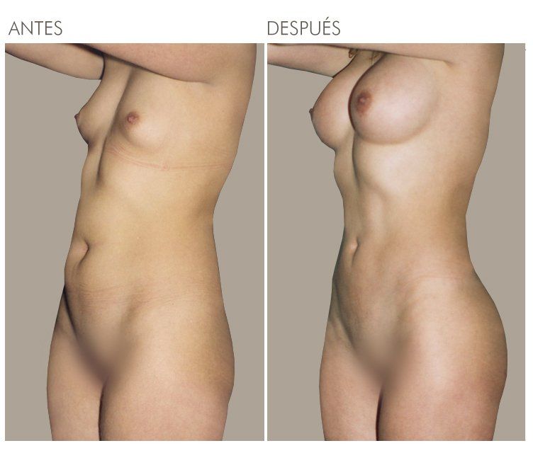 LIPOESCULTURA