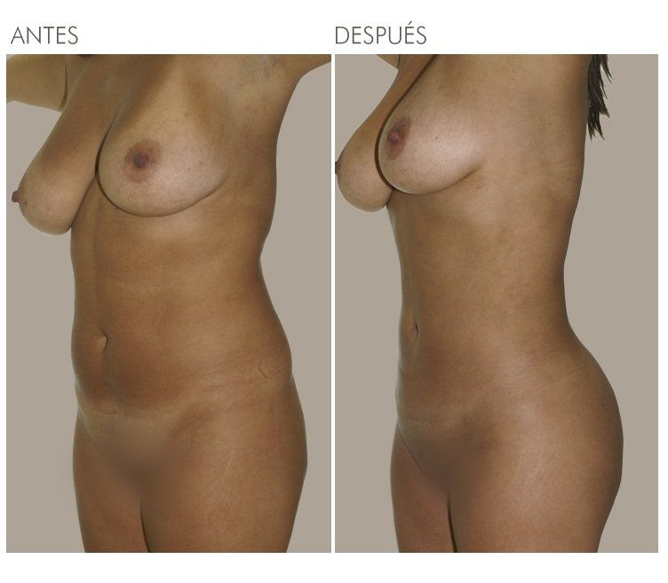 LIPOESCULTURA