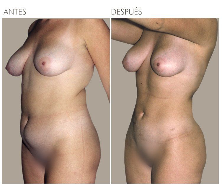 LIPOESCULTURA