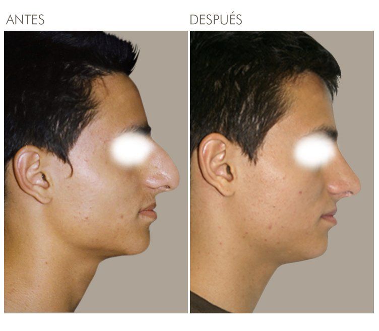 A before and after photo of a man 's nose