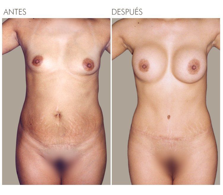 ABDOMINOPLASTIA
